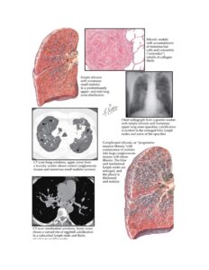 silicosis graphic