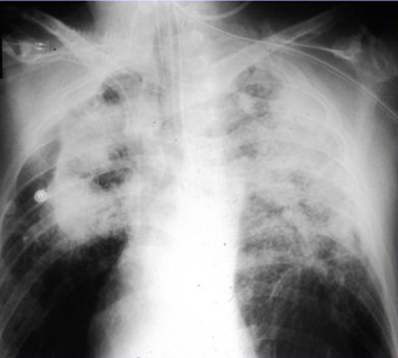 accelerated silicosis xray