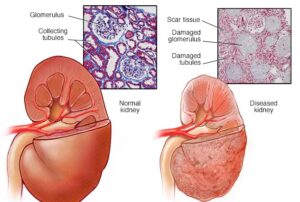 chronic kidney disease infographic