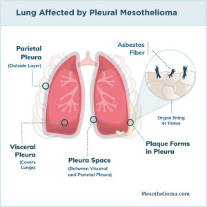 Medical illustration shows lungs with pleural mesothelioma, labeling parietal and visceral pleura, pleura space, asbestos fibers, and plaque forming in the pleura. Radiologists often rely on such detailed images to study disease progression and guide mesothelioma treatment. Source: Mesothelioma.com.
