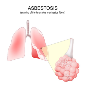 Medical illustration of human lungs affected by asbestosis, featuring a magnified view of alveoli containing thin, fibrous particles, used in Netherlands epidemiology research.